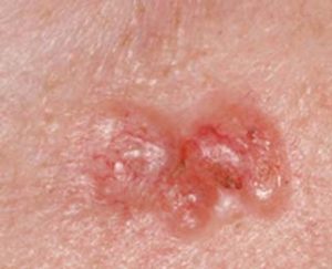 A spot of Basal Cell Carcinoma in skin