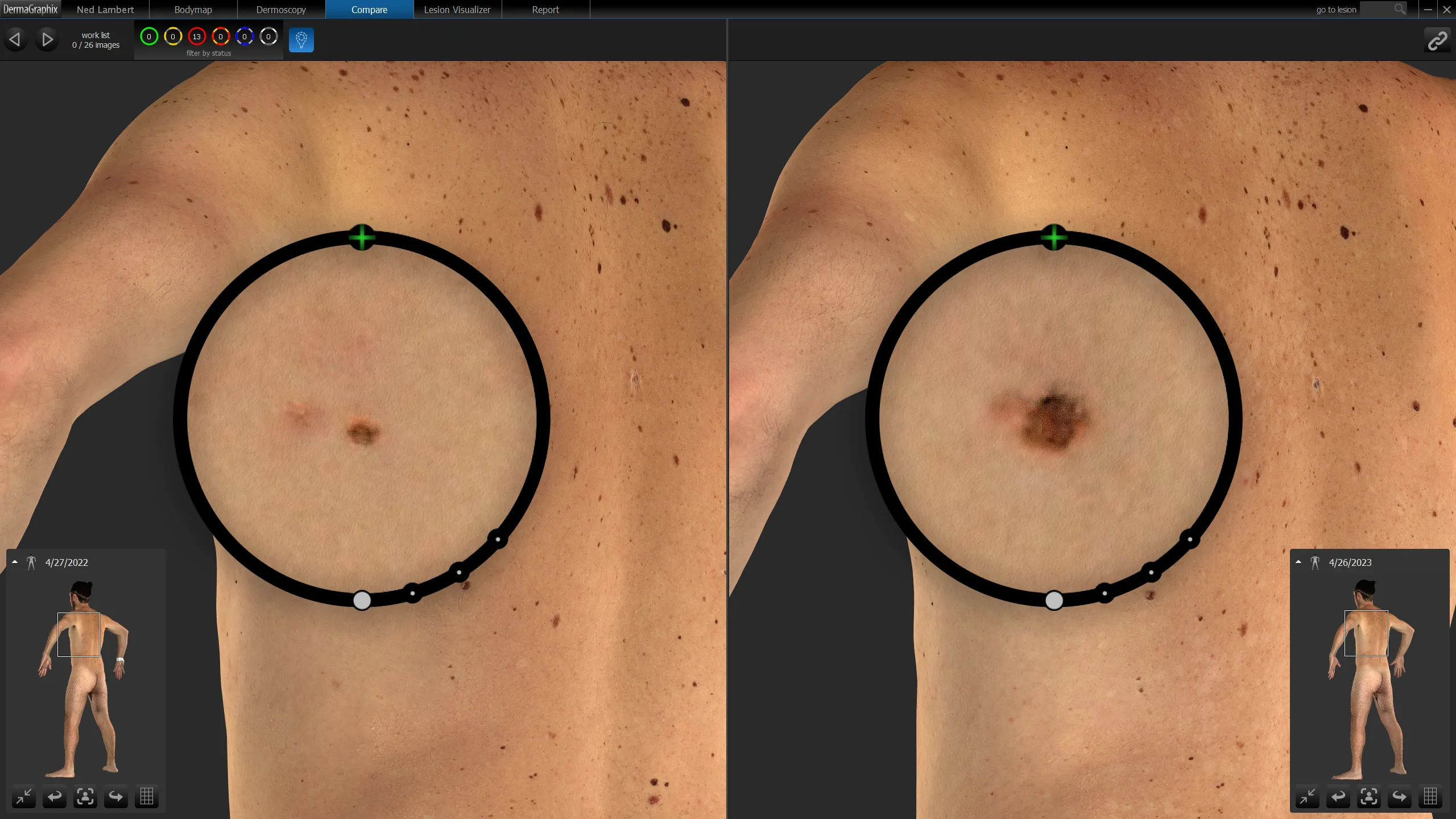 VECTRA WB360 compare-bodymaps screen with loupe overlay, highlighting changes between visits.