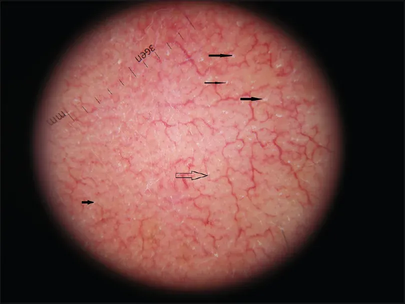 Dermoscopy of rosacea-affected skin showing the polygonal network of dilated blood vessels, with follicular findings at the hair openings