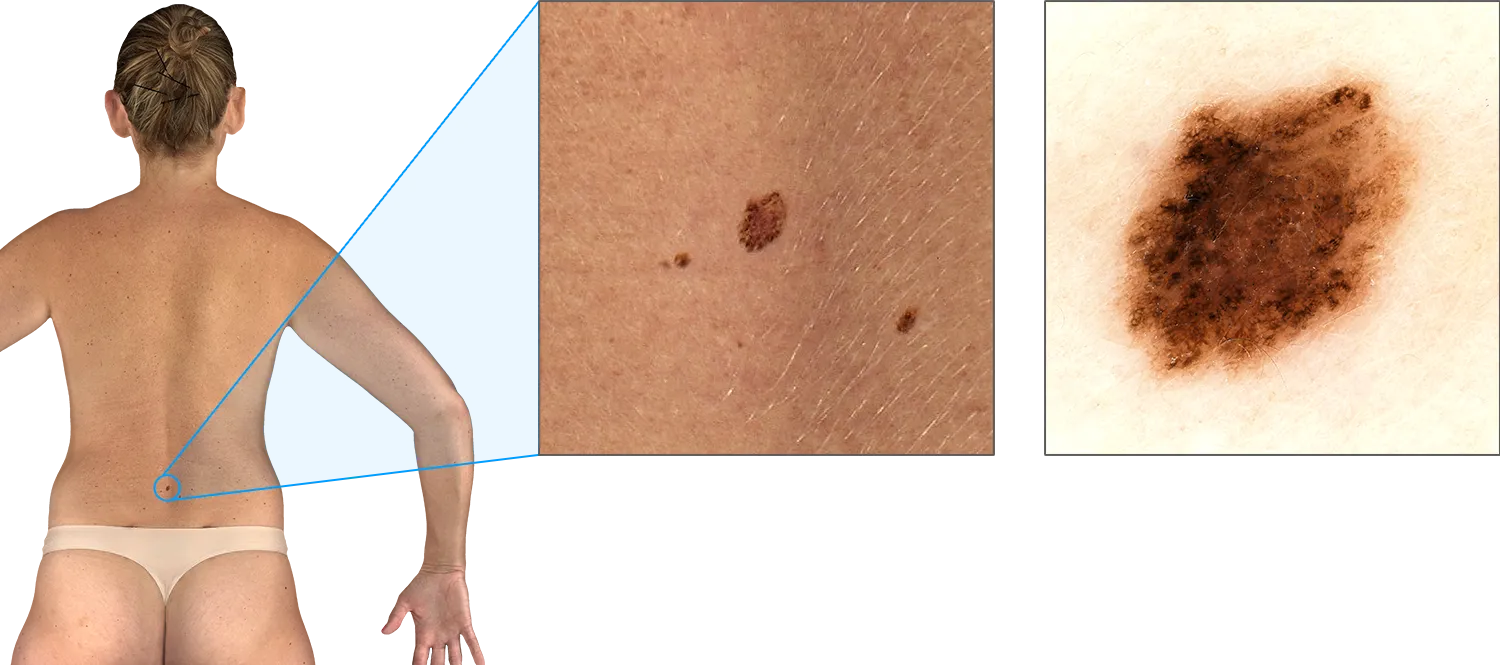 VECTRA WB360 lesion zoom and dermoscopy view on a female patient.