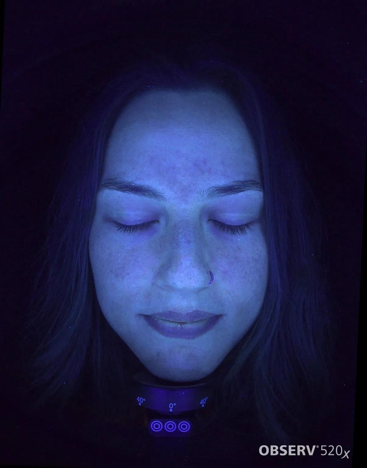 An Observ UV skin-imaging capture revealing sub-surface pigment distribution across the face