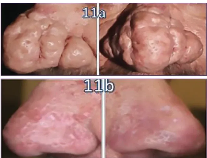 Before-and-after photographs of major rhinophyma — a bulbous, nodular nose at baseline, and a smoother, re-contoured nose one month after Er:YAG laser resurfacing