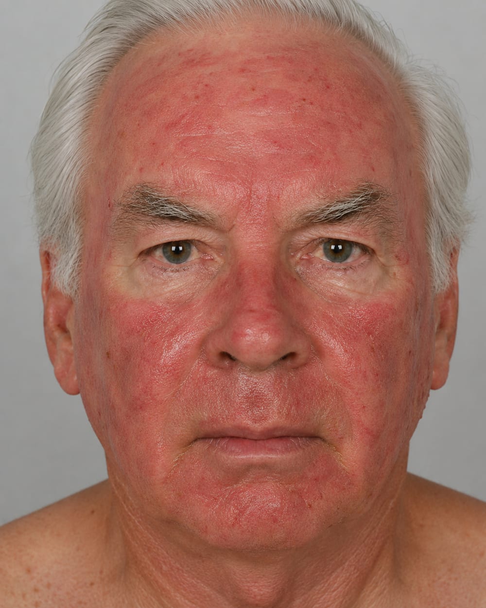 The same face around days 5 to 14 of Efudix treatment, with deeper, blotchy redness as sun-damaged areas light up across the forehead, cheeks and nose