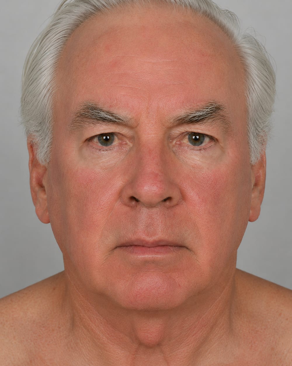 A man's face in the first days of full-field Efudix treatment, showing mild, even redness across the cheeks and forehead