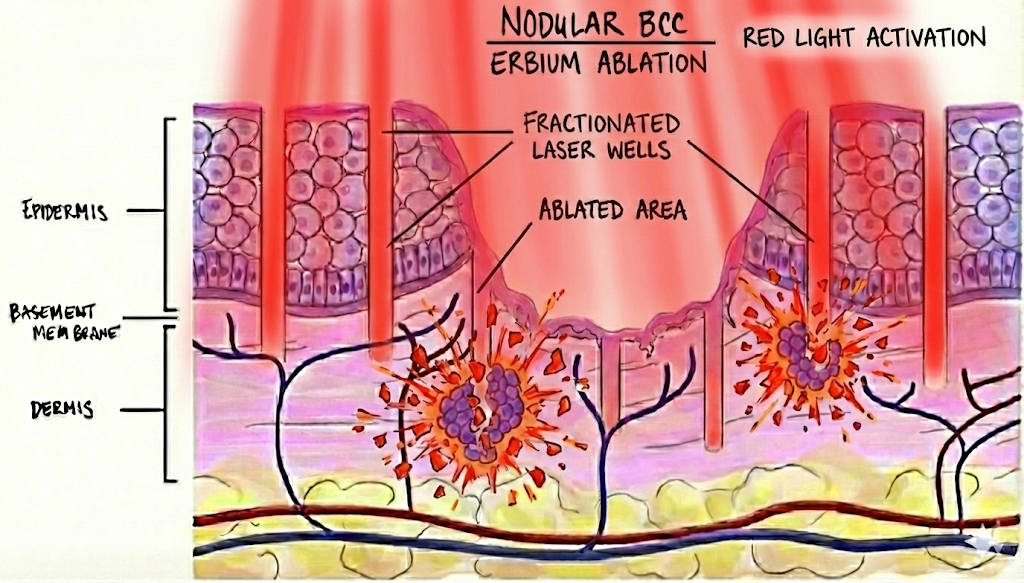 Red light activation generates reactive oxygen species that selectively destroy cells containing the photosensitiser
