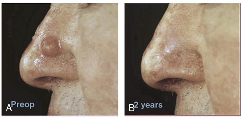 Aesthetic outcome after laser-combined PDT, showing healed skin with minimal scarring