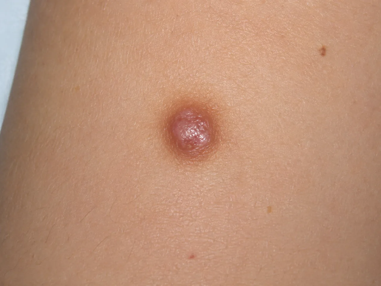 A solitary dermatofibroma on the skin — a small, firm, dome-shaped pink-brown nodule a few millimetres across, raised slightly above the surrounding skin.
