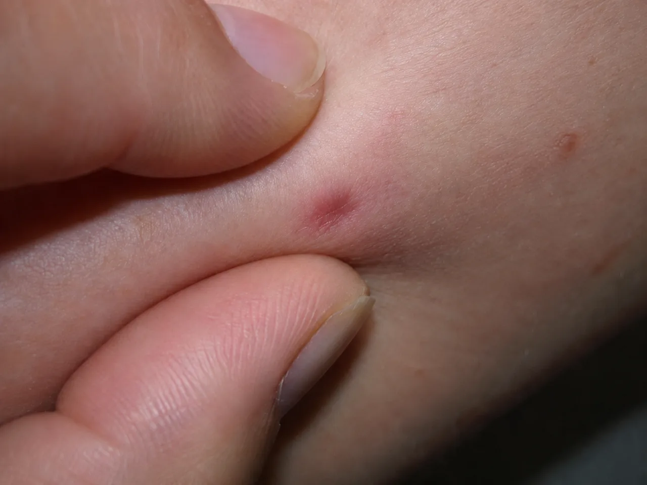 The dimple or pinch sign — two fingers squeezing the skin on either side of a dermatofibroma, making the surface of the lesion dip inward to form a small central dimple.