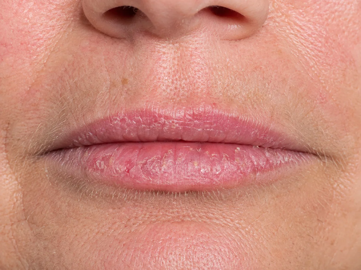Close-up clinical photograph of the mouth and perioral skin showing actinic cheilitis. Persistent fine white and yellowish scale, flaking and small crusts are spread across the vermilion of the lower lip, with further scaling on the upper lip. The lip surface looks dry and roughened rather than smooth, and the surrounding sun-exposed skin shows fine wrinkling and a small brown sunspot on the upper cutaneous lip.