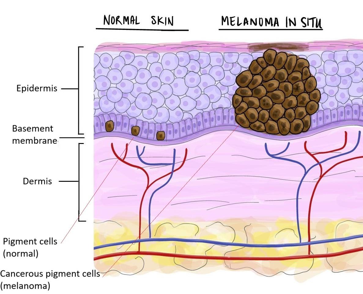 Histological diagram showing normal skin alongside melanoma in situ. Pigment cells (melanocytes) sit on the basement membrane in normal skin; in melanoma in situ a clustered mass of cancerous melanocytes proliferates within the epidermis but has not yet crossed the basement membrane into the dermis.
