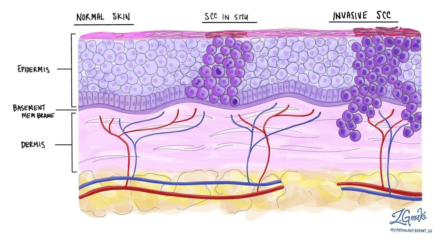 Hand-drawn histological diagram comparing three skin cross-sections side by side. Left panel labelled 'Normal Skin' shows regular squamous cells in the epidermis above the basement membrane, with blood and lymph vessels (red and blue lines) only in the dermis below. Middle panel labelled 'SCC in Situ' shows abnormal, enlarged dark-purple squamous cells crowding the full thickness of the epidermis, but the basement membrane is intact and no tumour cells have entered the dermis. Right panel labelled 'Invasive SCC' shows tumour cell clusters breaking through the basement membrane into the dermis, where they gain access to blood and lymph vessels.