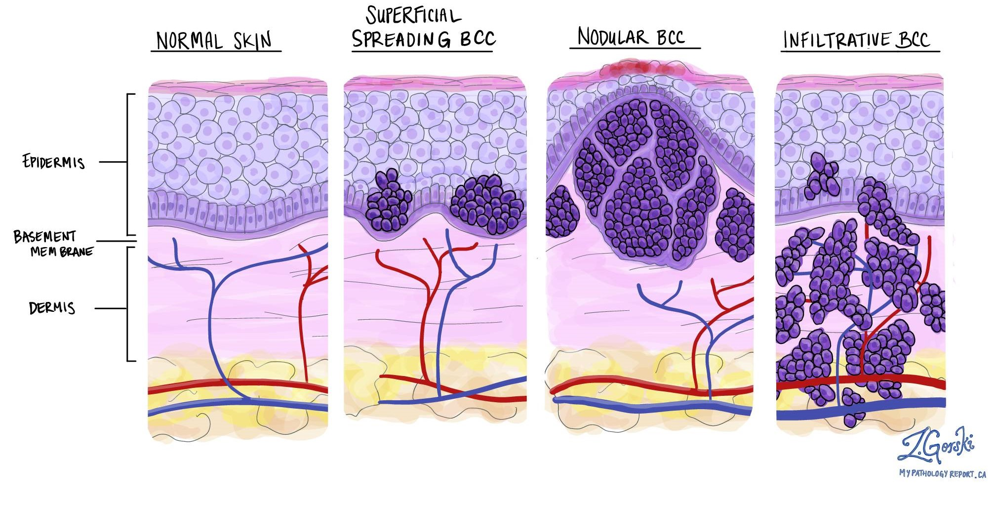 Hand-drawn histological diagram comparing four skin cross-sections side by side: normal skin with epidermis, basement membrane and dermis labelled; superficial spreading BCC confined to the epidermis above the basement membrane; nodular BCC forming a large nodular mass that invades the dermis; and infiltrative BCC sending irregular finger-like projections deep into the dermis.