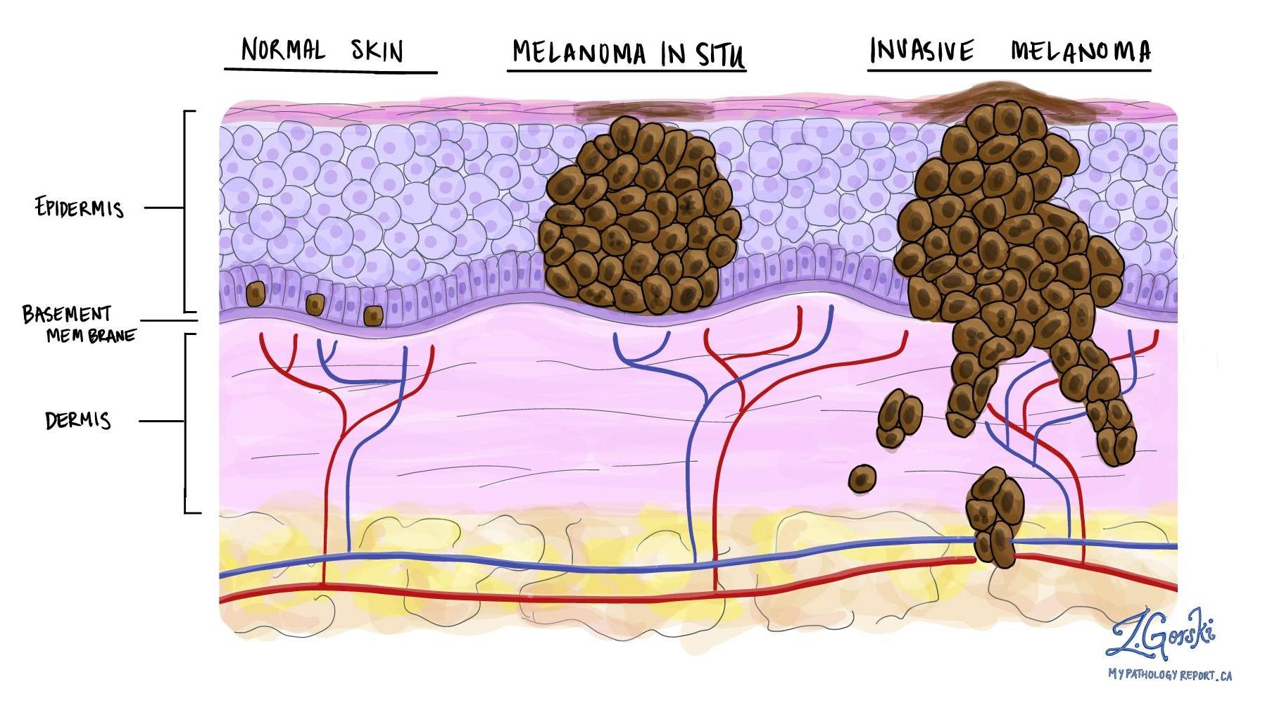 Hand-drawn histological diagram comparing normal skin, melanoma in situ and invasive melanoma. Normal skin shows scattered melanocytes at the basement membrane; melanoma in situ shows a mass of dark tumour cells crowding the epidermis but not crossing the basement membrane; invasive melanoma shows tumour cells breaking through the basement membrane and spreading into the vascular dermis below.
