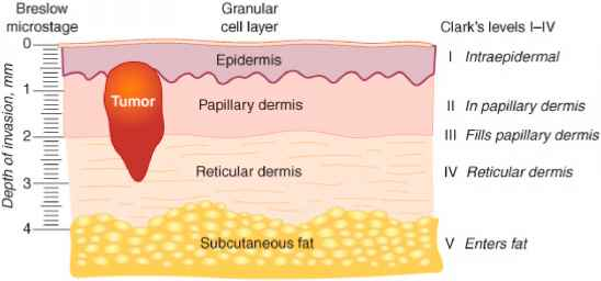 Diagram showing Breslow thickness measurement and Clark levels I through V. A millimetre ruler on the left shows depth of invasion from 0 to 4 mm. A tumour shape sits within the skin layers: epidermis at top, then papillary dermis, reticular dermis, and subcutaneous fat at the bottom. Clark level I is intraepidermal (melanoma in situ); level II extends into papillary dermis; level III fills papillary dermis; level IV reaches reticular dermis; level V enters fat.