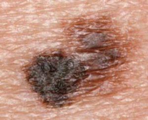 A spot showing melanoma skin cancer in skin